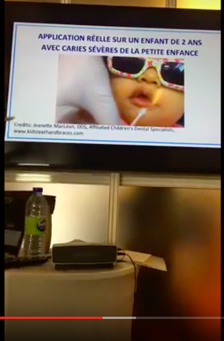 Video of our JDIQ Presentation on Silver Diamine Fluoride, FluoriMax & Plaque HD