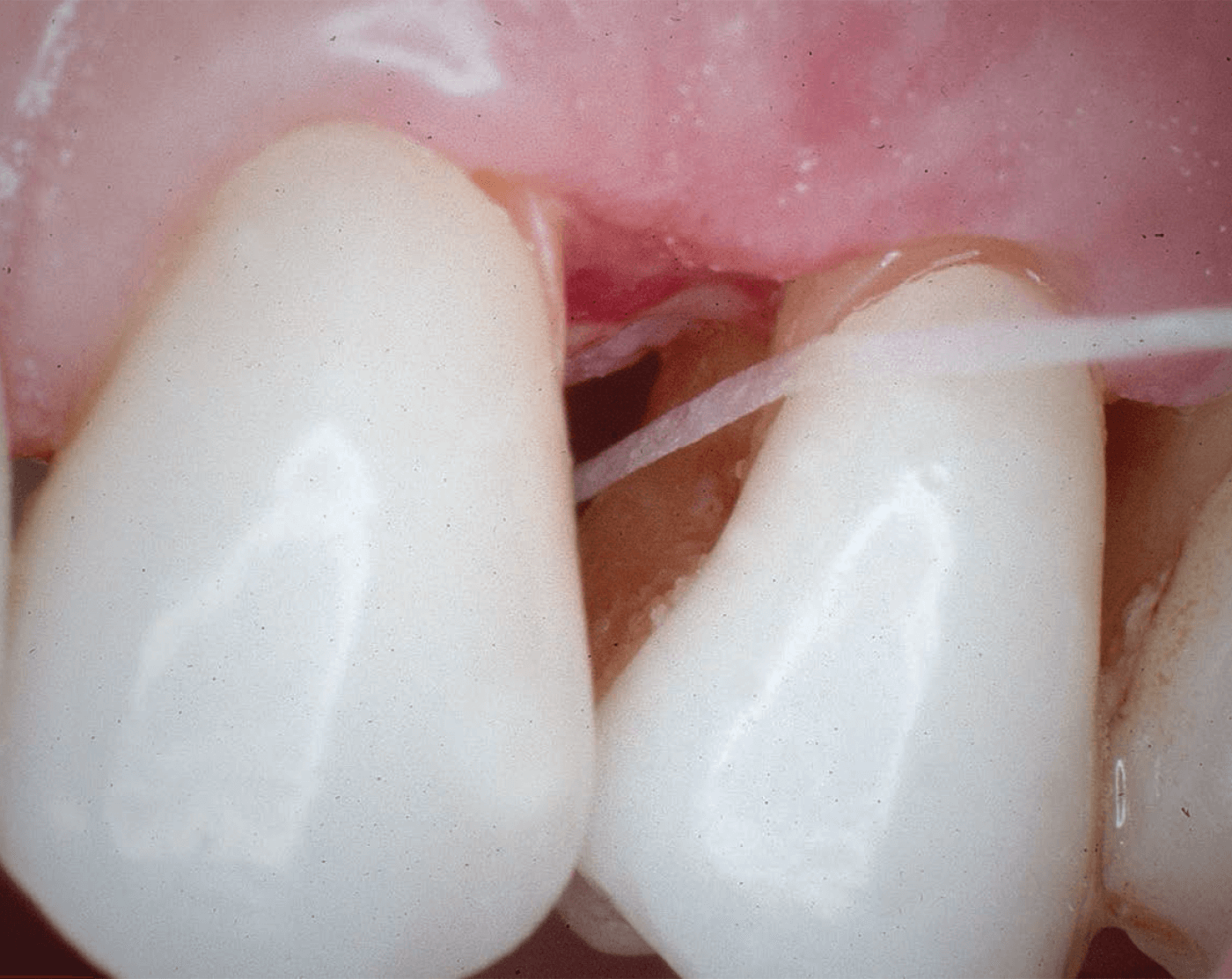 Periodontal Disease: An Interproximal Disease
