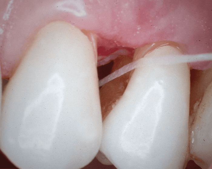 Periodontal Disease: An Interproximal Disease