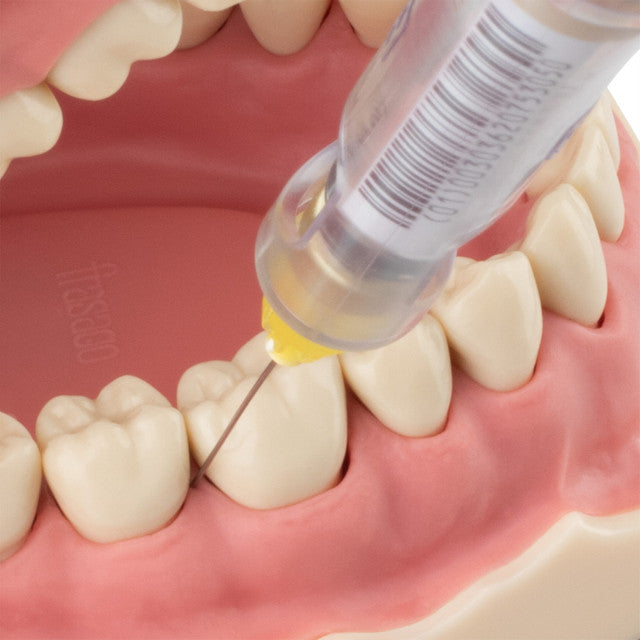 Woodpecker - Super Pen - Electronic Anesthesia Delivery Syringe System