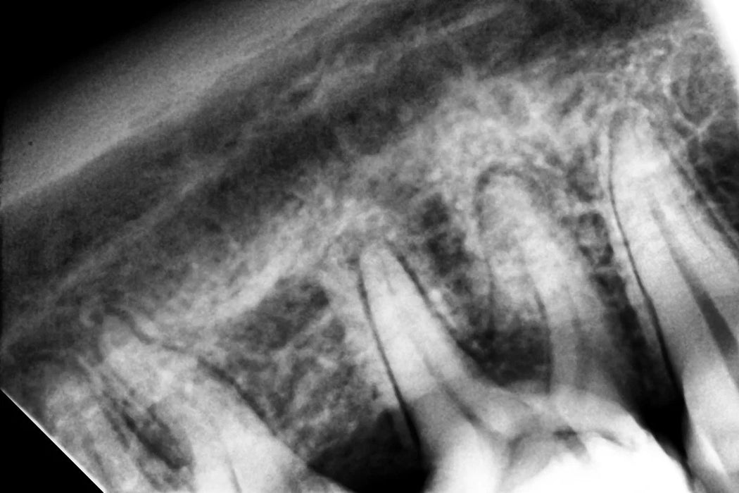 Woodpecker - i-Sensor - Digital X-Ray Sensor - Oral Science