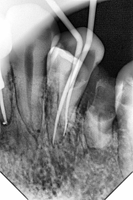 Woodpecker - i-Sensor - Digital X-Ray Sensor - Oral Science